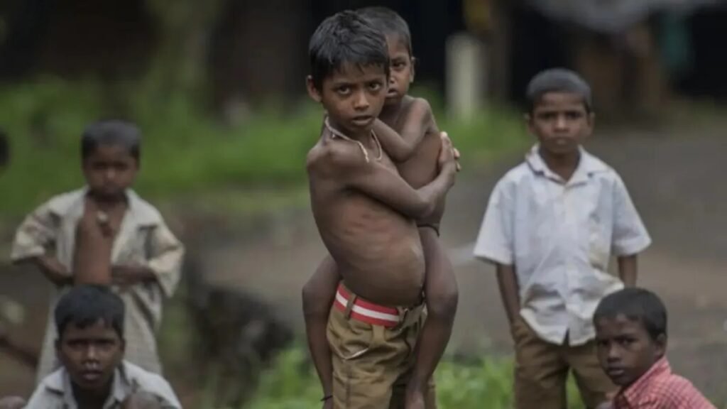 malnourished children